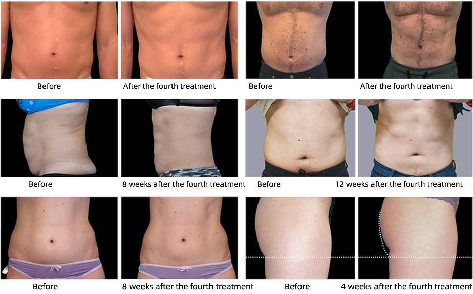 Aparat Stimulare Musculara Electromagnetica EMS Pro Sculpt cu 4 capete.