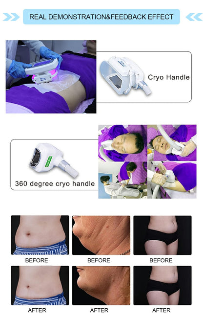 Aparat Criolipoliza 360 CryoSoft Pro cu 5 Capete, pana la -16 Grade,1600W