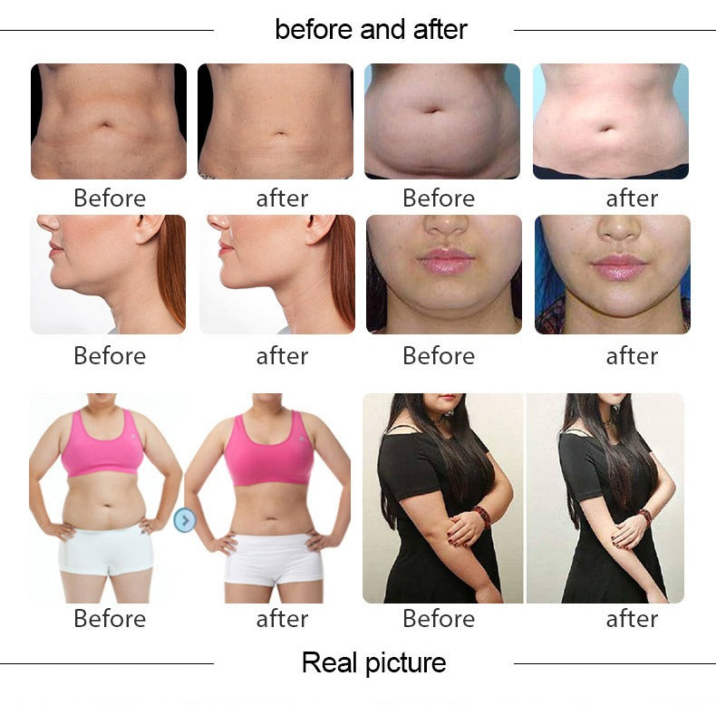 Aparat Criolipoliza Crioterapie cu 2 Capete, Cryneo