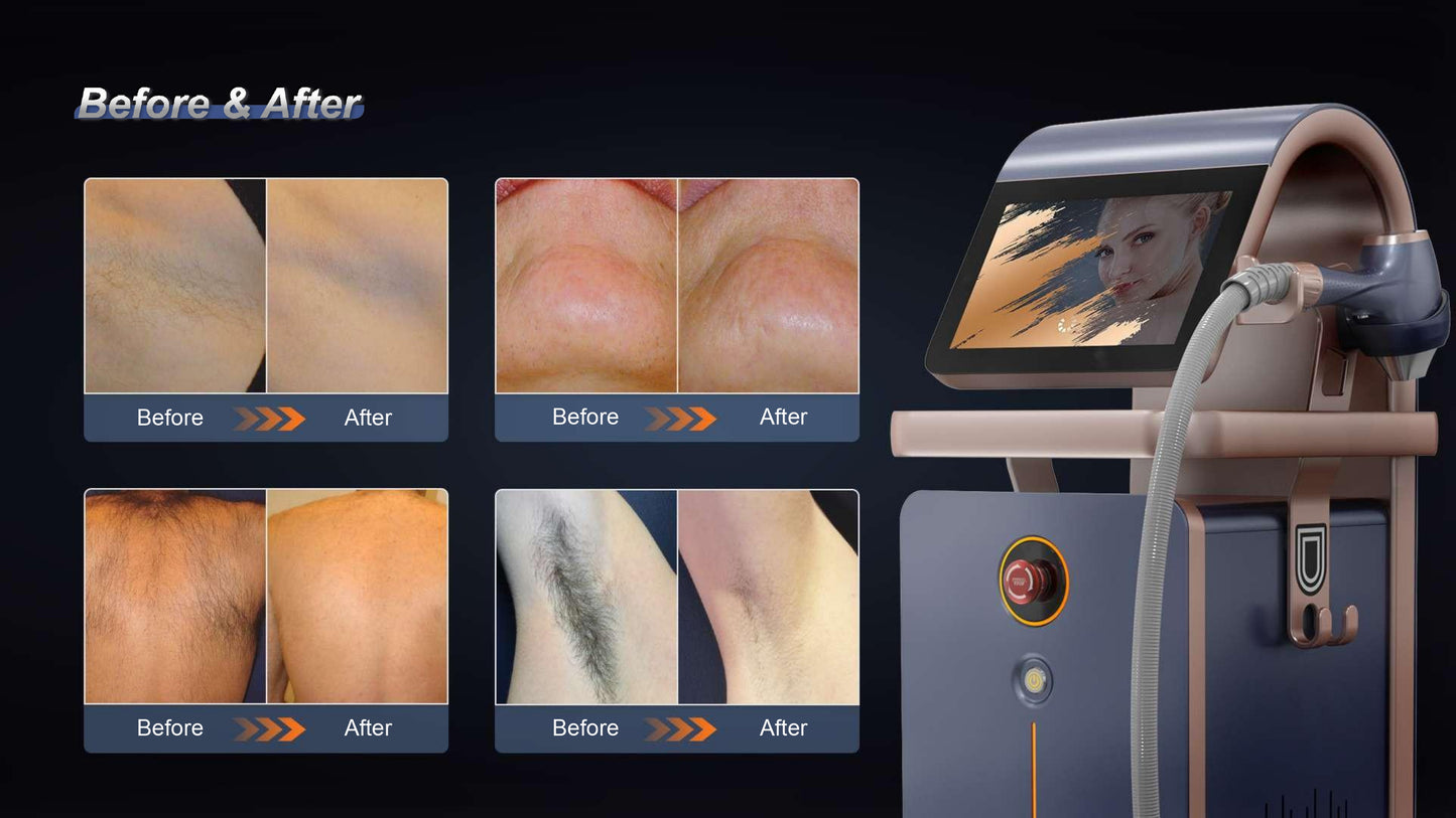 Aparat de Epilare Definitiva cu 4 Lungimi de Unda, Fedora, soft Inteligenta Artificiala, dioda 1800W, Putere Aparat 4500W cu capete interschimbabile