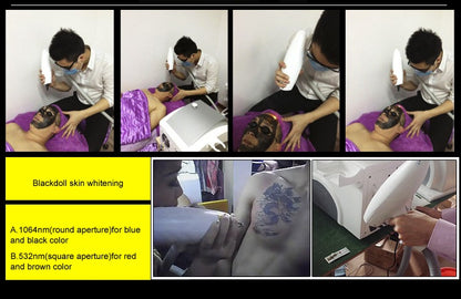Aparat pentru Indepartarea Tatuajelor ReTattoo, cu Laser - laser nd yag