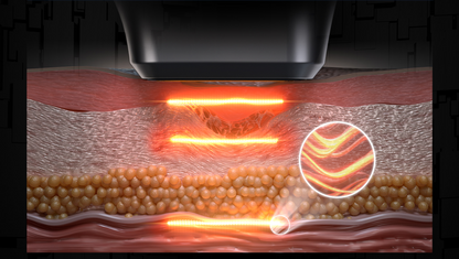 Hifu 12D Max -  Ultima Generatie - Rejuvenare, Reintinerire, Lifting Facial si Corporal