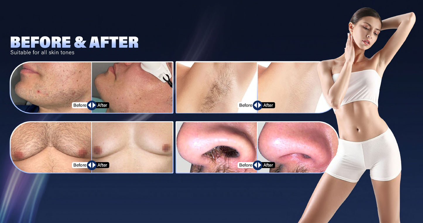 LumiNex Pro – Aparat Profesional Laser Diodă 4 Lungimi de Undă pentru Epilare Definitivă