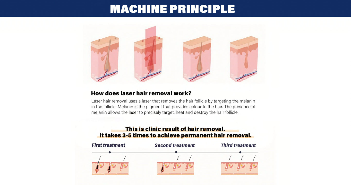 LumiNex Pro – Aparat Profesional Laser Diodă 4 Lungimi de Undă pentru Epilare Definitivă