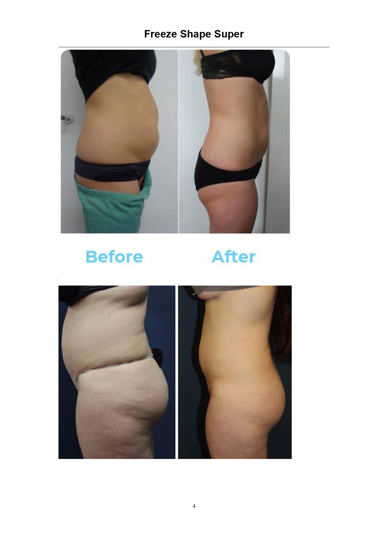 Super Shape Freeze Lipo - Aparat Electrostimulare, Radiofrecventa si Criolipoliza