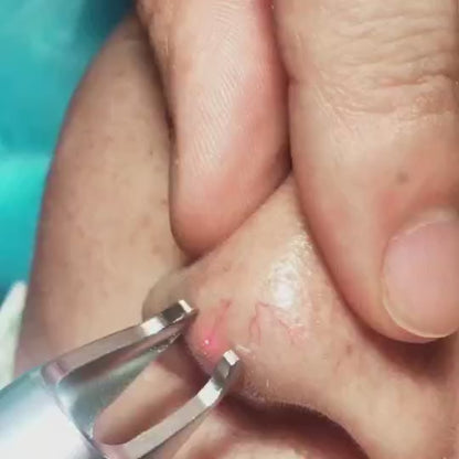 Aparat pentru Capilare Sparte Spider Veins